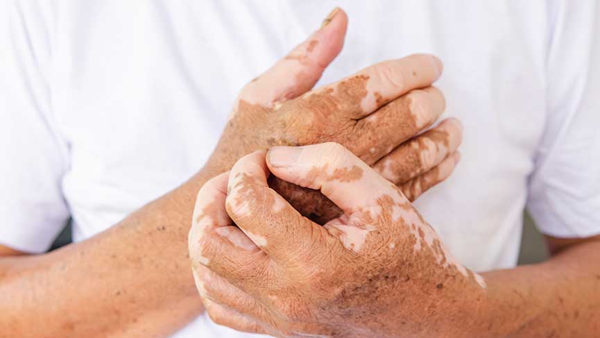 Topical Collagen Application for Vitiligo: A Promising Treatment Option