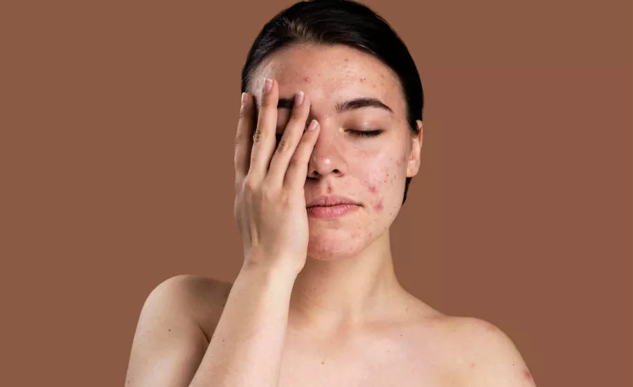 5 unexpected side effects on acne medication Accutane