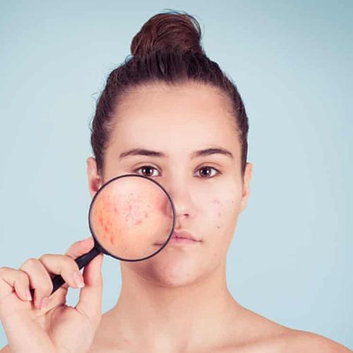 Seven ways ... to manage Acne