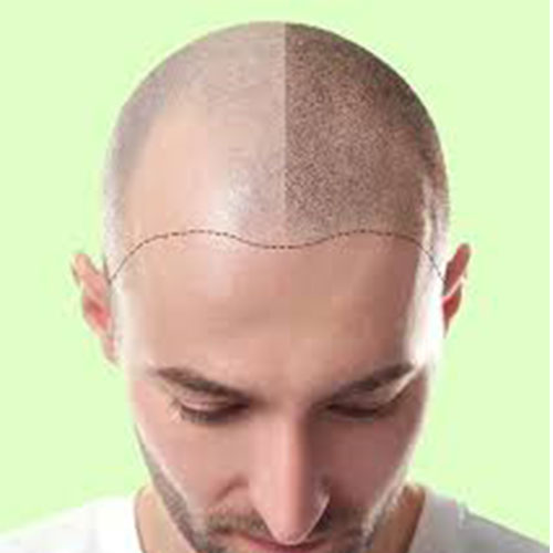 5 Tips for Recovering from Hair Transplant Surgery