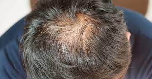 Latanoprost: a novel approach to combat androgenic alopecia