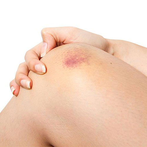 12 Ways to Get Rid of Bruises, Fast!