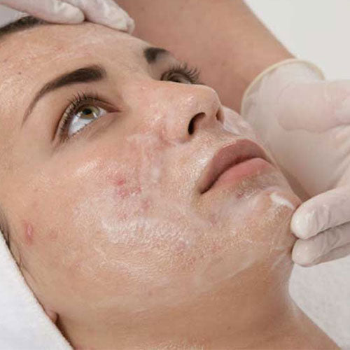How To Care For Your Skin After A Chemical Peel