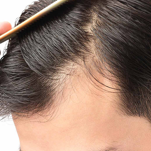 7 Reasons Your Hair Is Thinning | Hair Loss prevention