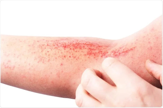 Atopic Dermatitis and Genetics: Insights from Recent Research